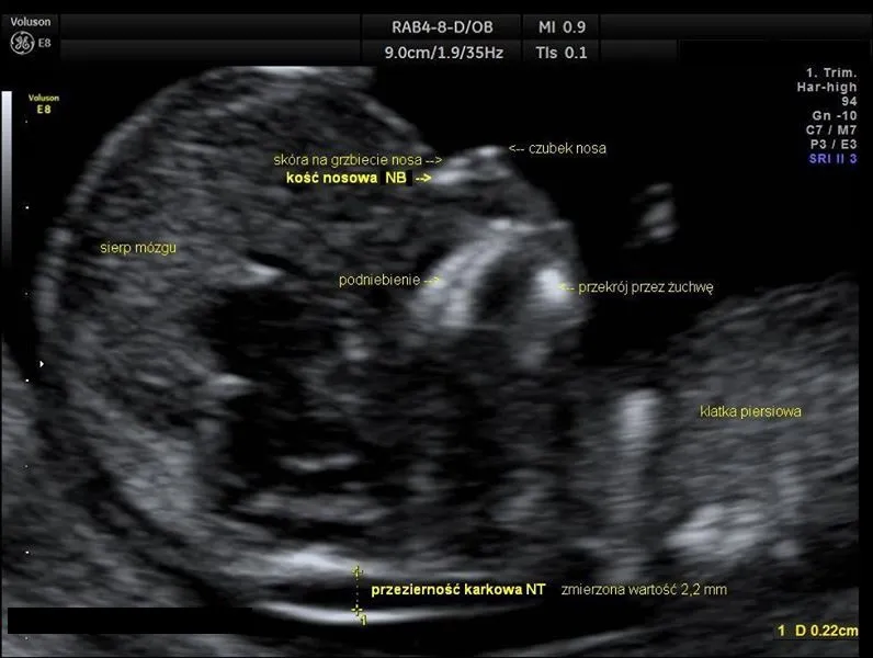 USG genetyczne I trymestru
