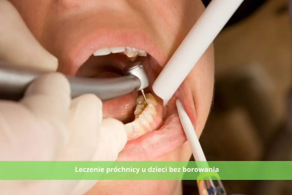 leczenie próchnicy bez borowania