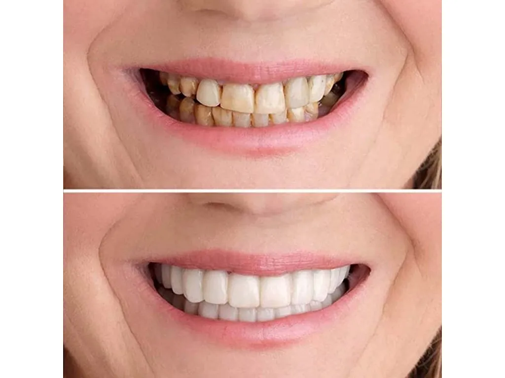 nakładki kosmetyczne na zęby przed i po