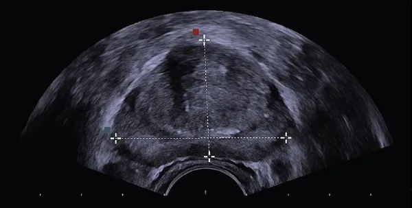 obraz usg prostaty trus