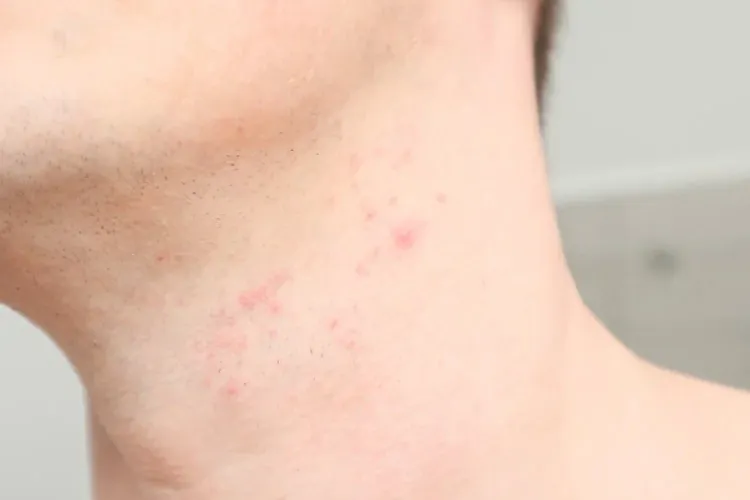 Podrażniona skóra po goleniu, czerwone krostki, zaczerwienienie