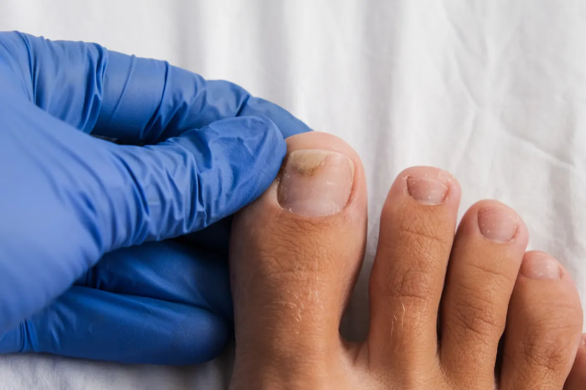 Grzybica paznokci objawy