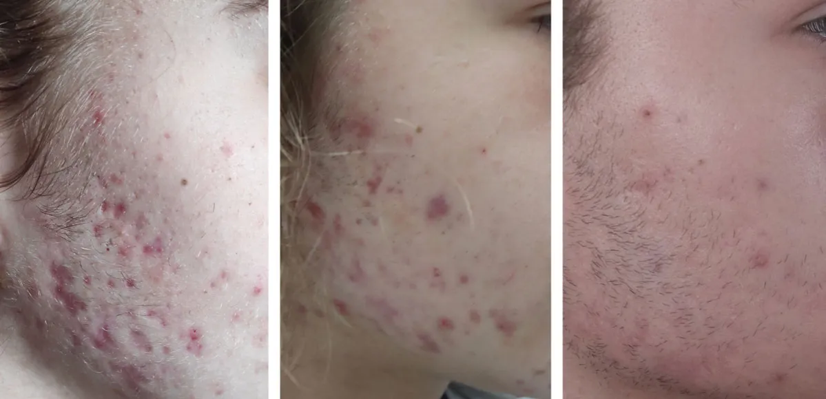 Skóra przed i po trądziku