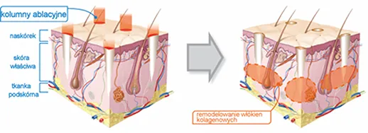 mechanizm działania lasera na włos, selektywna fototermoliza