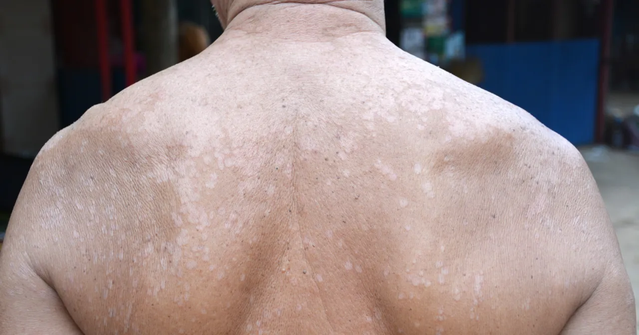 łupież pstry objawy na sk&oacute;rze