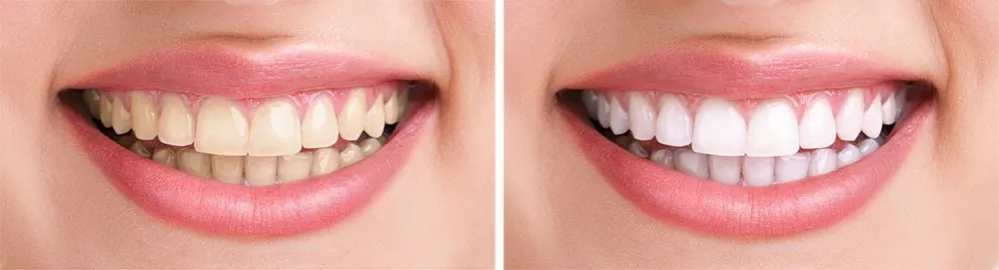 Wybielanie zęb&oacute;w w gabinecie stomatologicznym