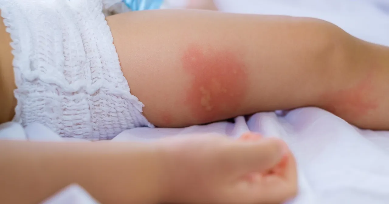 pediatra bada dziecko z wysypką