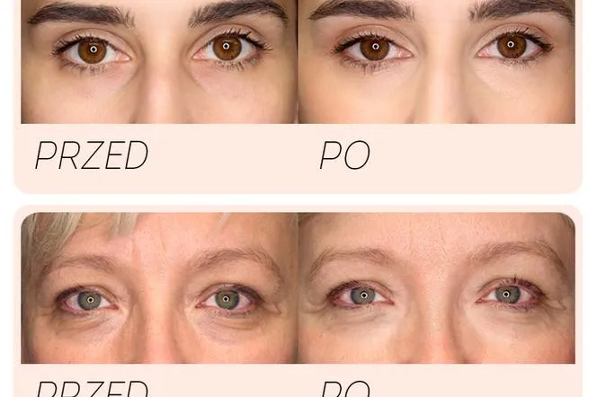 krem rozświetlający pod oczy przed i po efekty