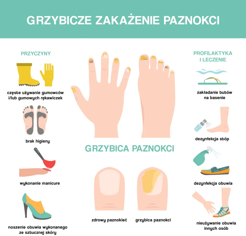 Profilaktyka grzybicy paznokci