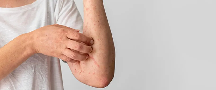 osoba z wysypką po leku, objawy alergii sk&oacute;rnej