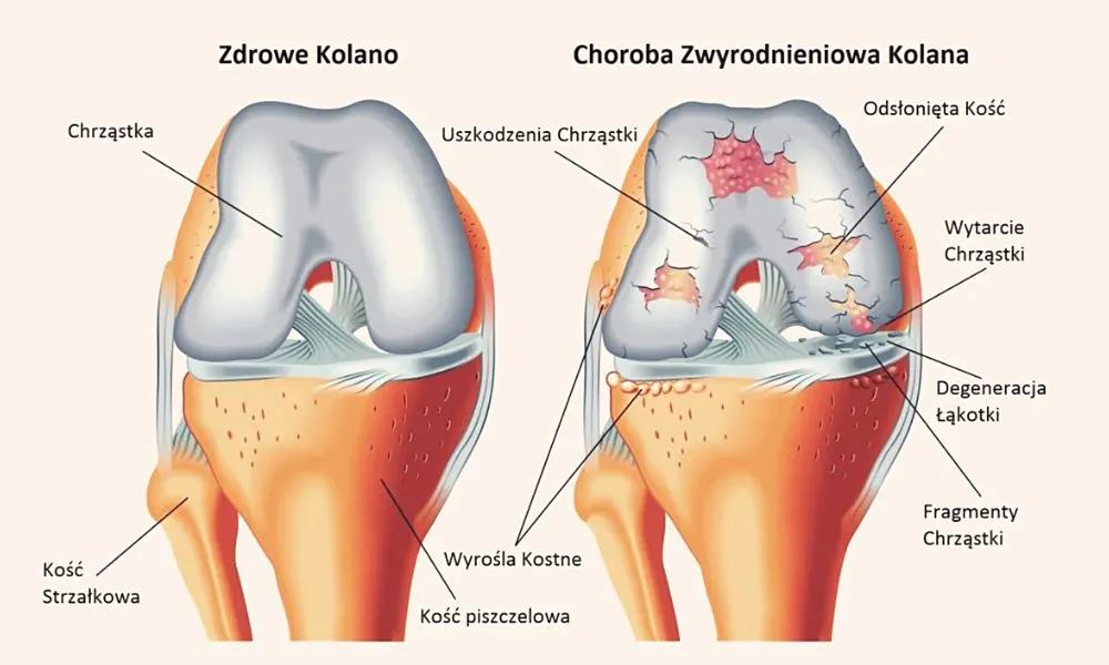 schemat działania siarczanu chondroityny na staw