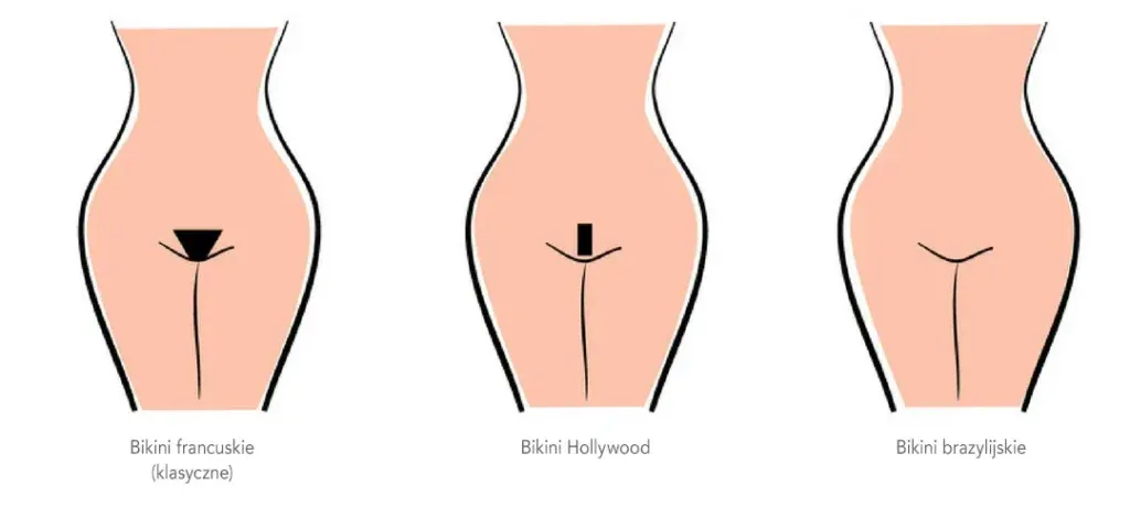 depilacja laserowa bikini