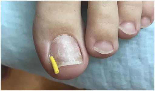 Podolog leczenie wrastającego paznokcia