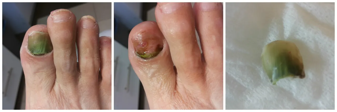 zielony paznokieć pseudomonas aeruginosa wygląd