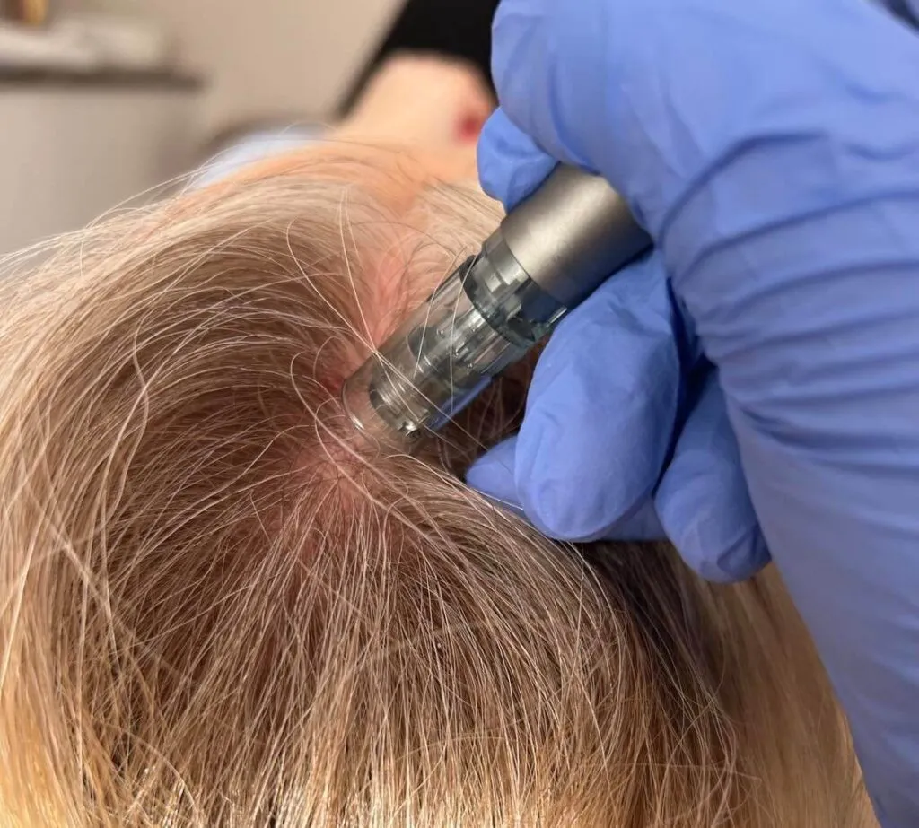 mezoterapia igłowa skóry głowy