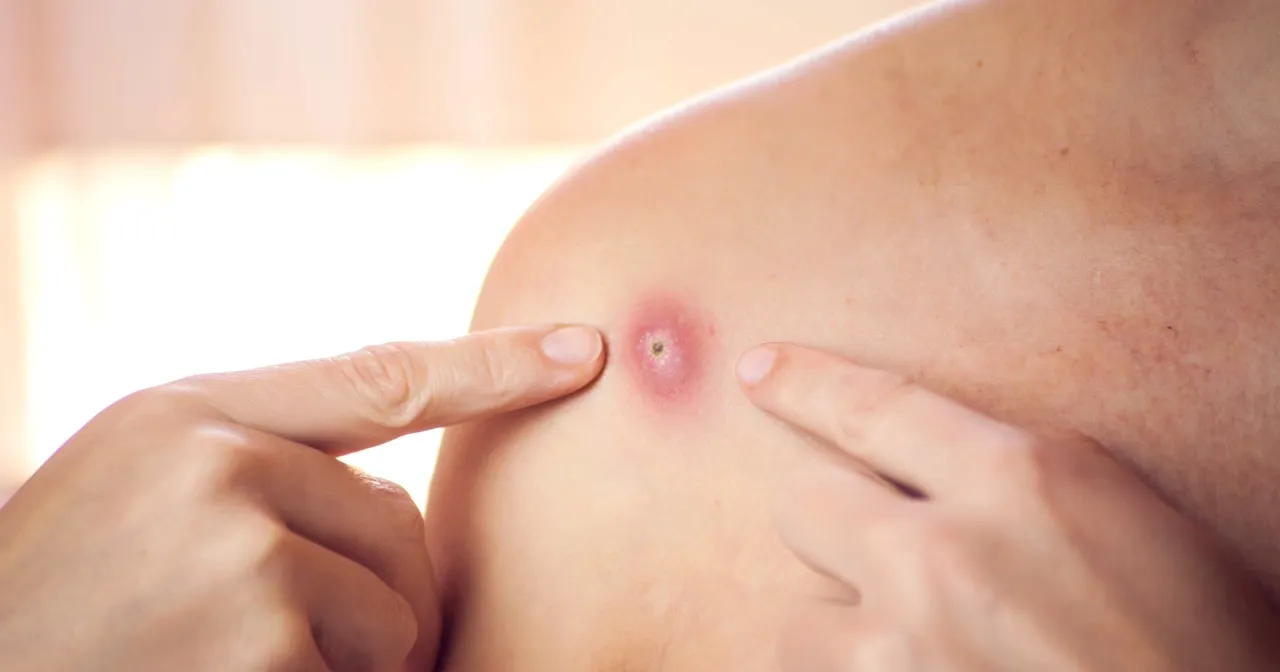 pielęgnacja rany po pryszczu, pierwsza pomoc sk&oacute;ra