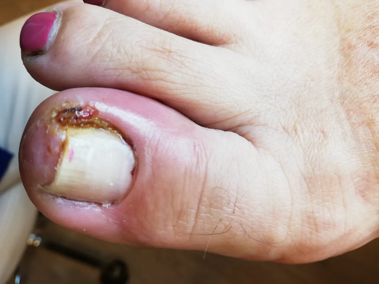 stopnie zaawansowania wrastającego paznokcia