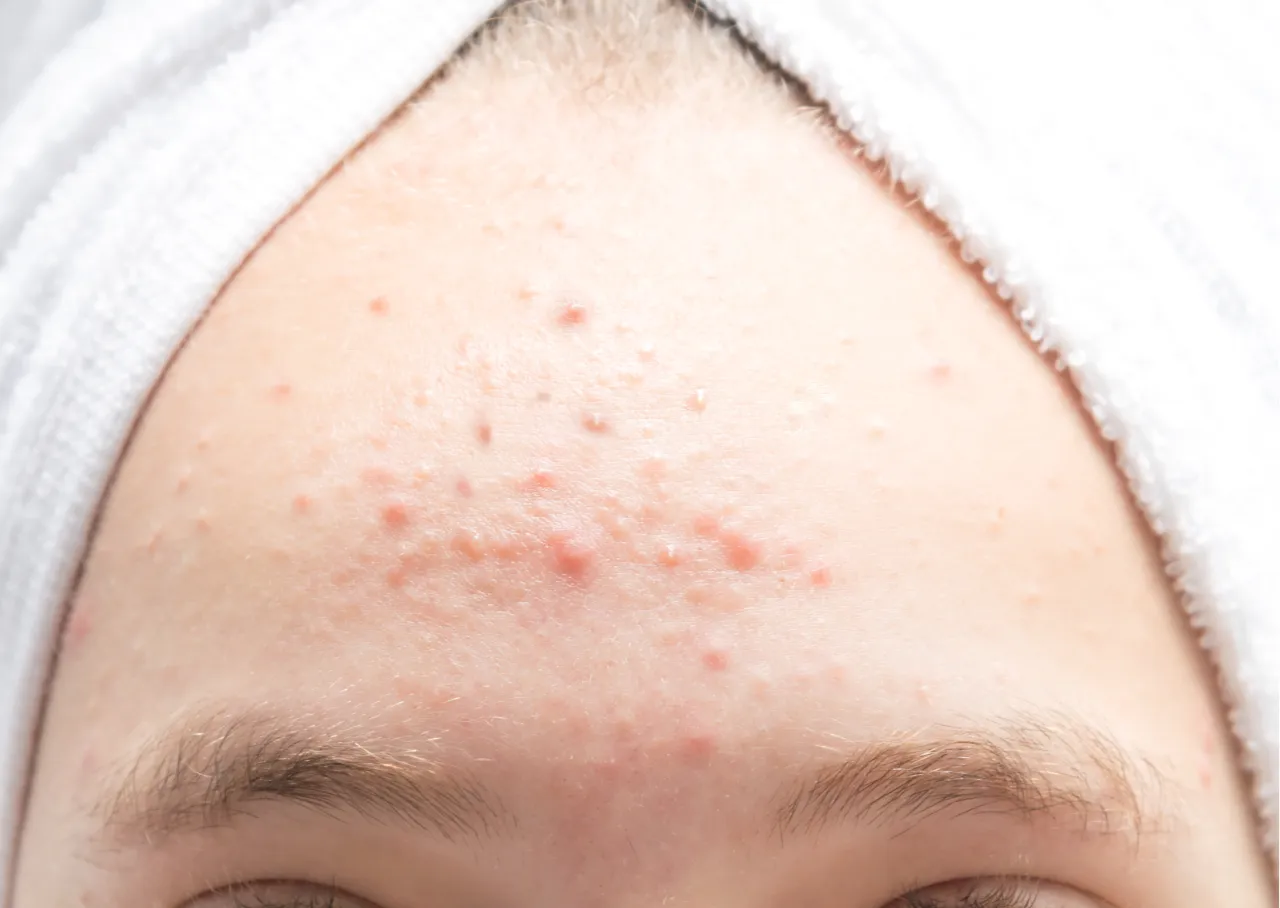 Hormonalne pryszcze na czole