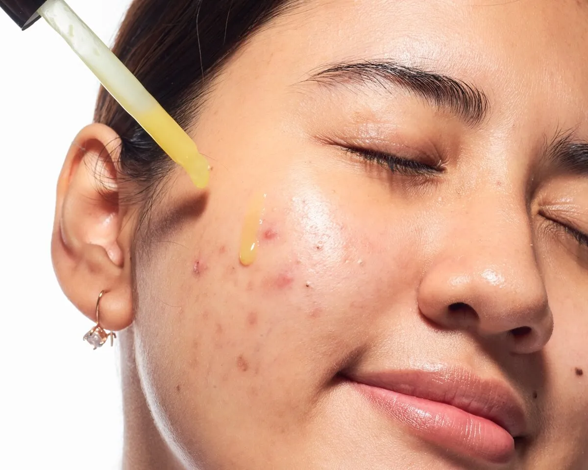 Składniki aktywne na pryszcze grafika