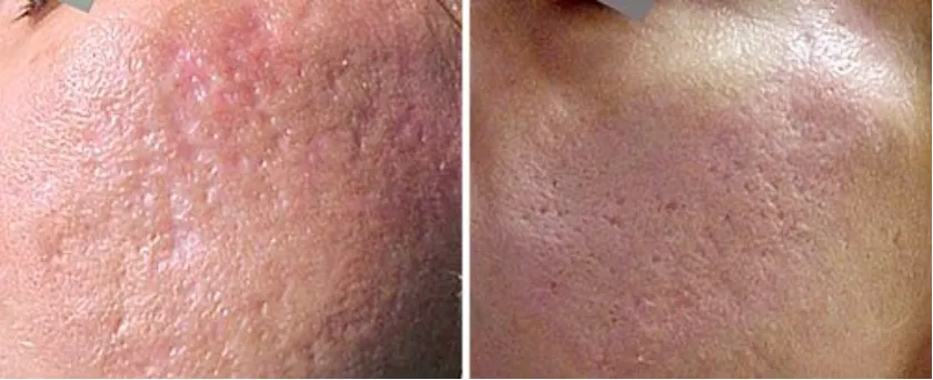 zabiegi na przebarwienia, laseroterapia, peeling chemiczny