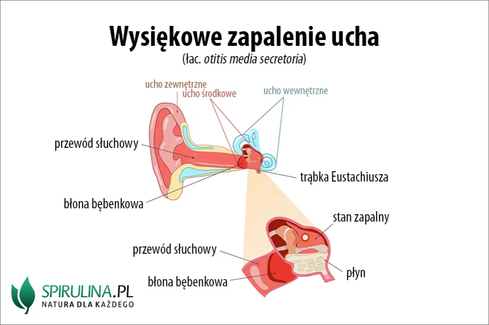 dziecko z wysiękowym zapaleniem ucha