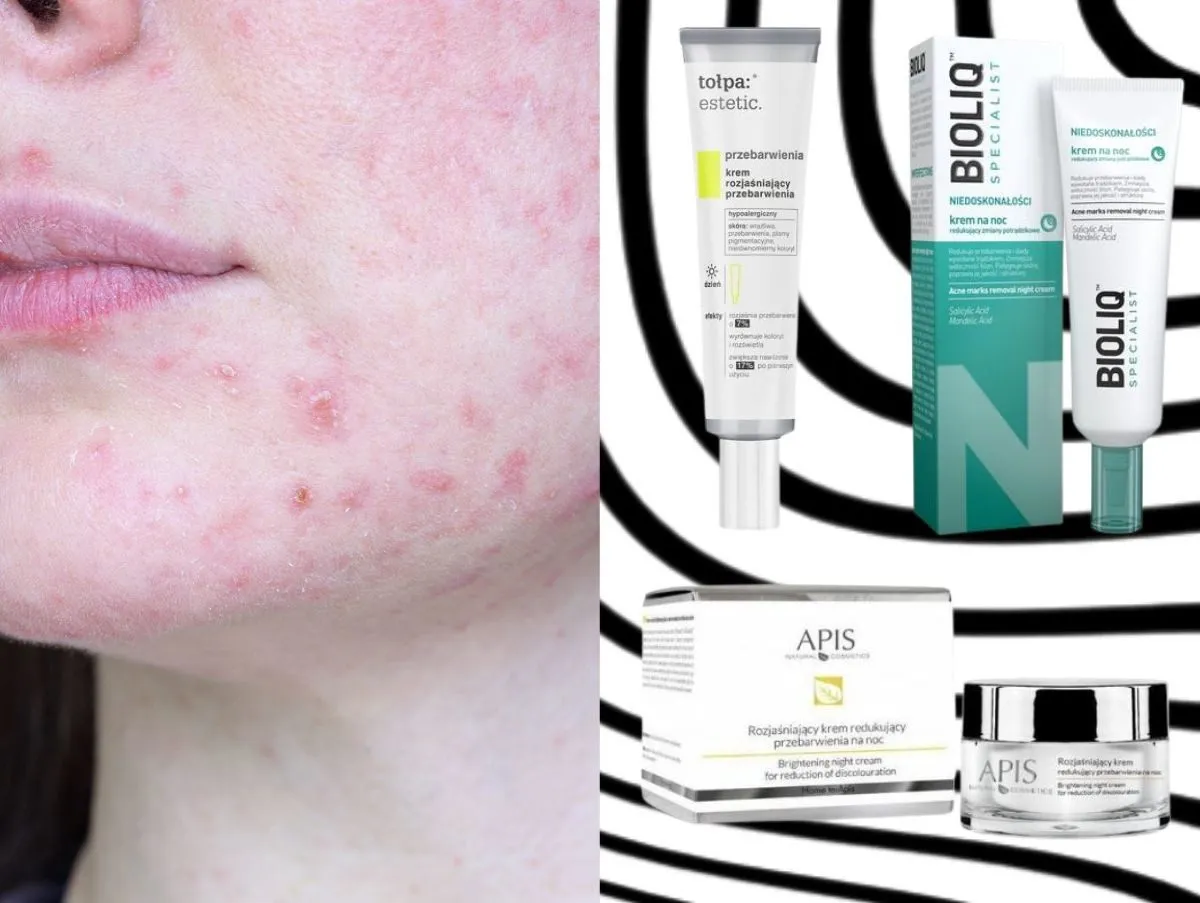 Skóra z niedoskonałościami i zaczerwienieniami. Obok kosmetyki, które pomogą zredukować co na rany po pryszczach.