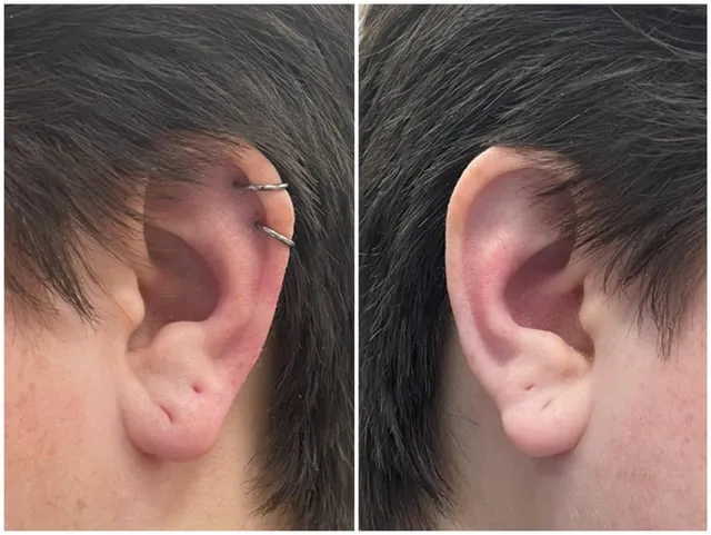 zagojone przekłucie ucha