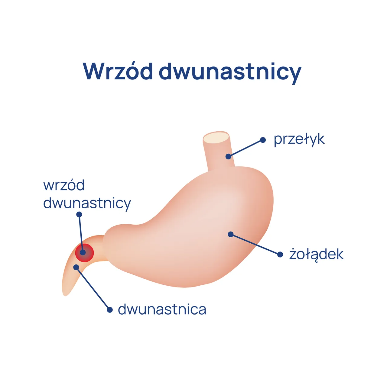 czynniki ryzyka wrzodów dwunastnicy