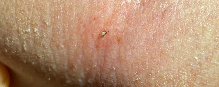 kleszcz na skórze zbliżenie