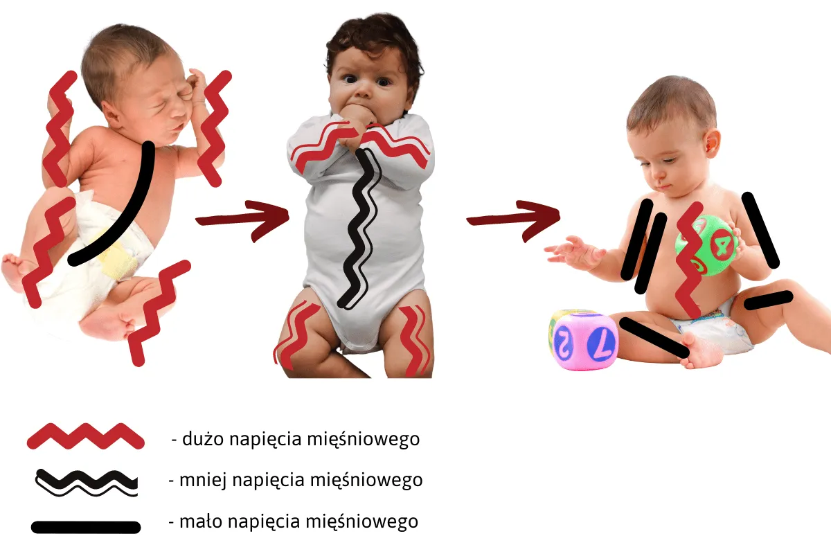 niemowlę wzmożone napięcie mięśniowe objawy