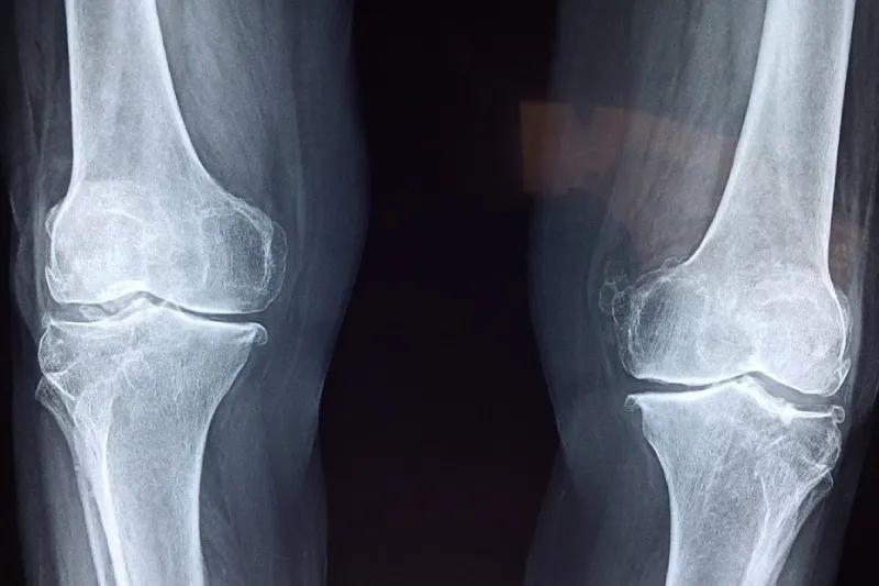 Zdjęcie Peut-on courir avec arthrose au genou sans aggraver la douleur ?