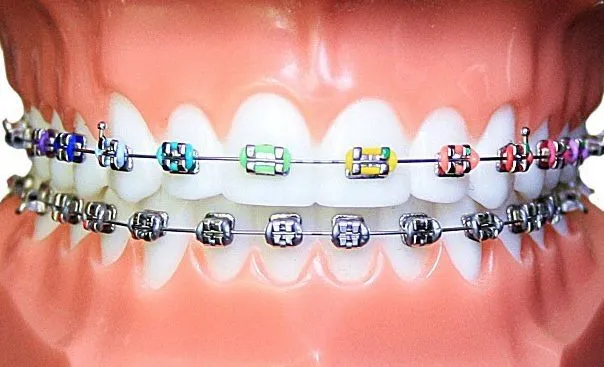 R&oacute;żne typy aparat&oacute;w ortodontycznych metalowy samoligaturujący