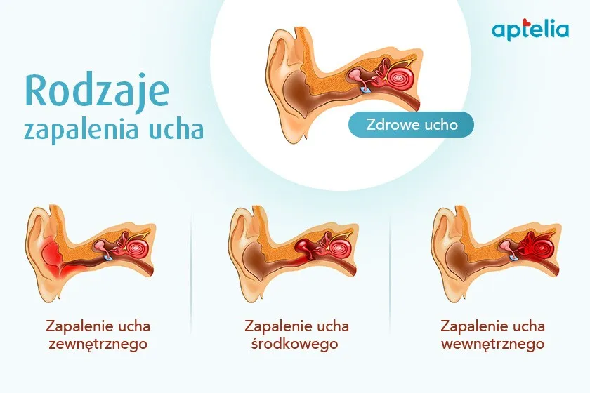 ryzyko powikłań zapalenia ucha