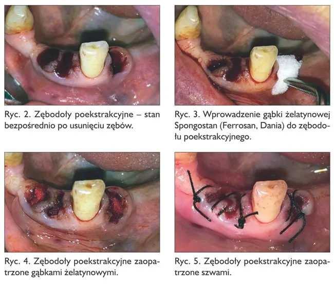 Pielęgnacja dziąsła po ekstrakcji zęba, skrzep krwi po usunięciu zęba