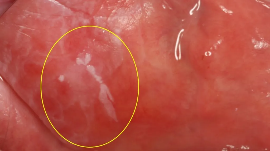 leukoplakia erytroplakia zdjęcia