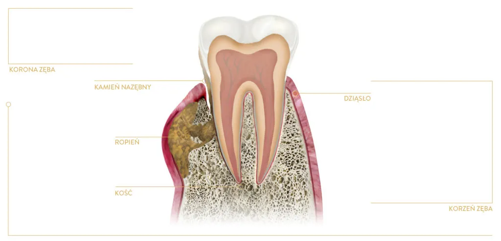 leczenie ropnia zęba dentysta