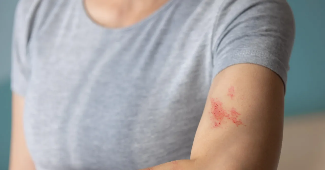 Skóra z wysypką, która może sugerować półpasiec. Warto skonsultować się z lekarzem, jakie leki na półpaśca będą najskuteczniejsze.