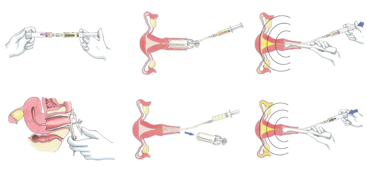 Przygotowanie do badania drożności jajowodów