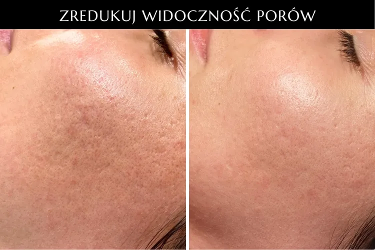 makijaż blizny potrądzikowe przed po