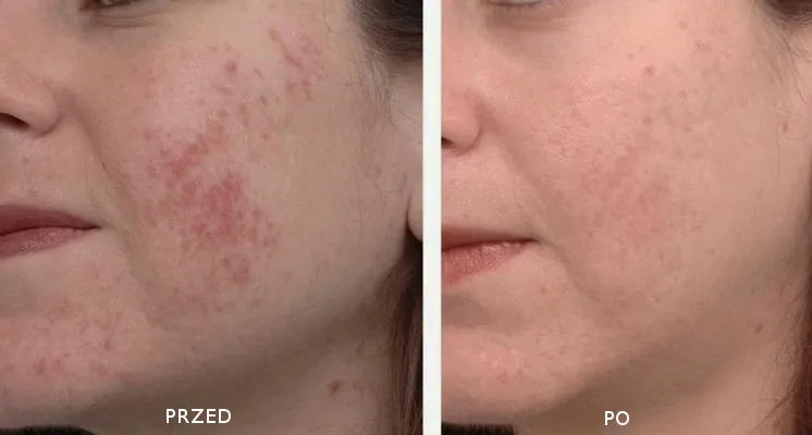 Profesjonalne zabiegi na przebarwienia przed i po