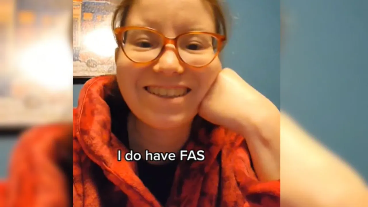 dziecko z FAS, charakterystyczne cechy twarzy