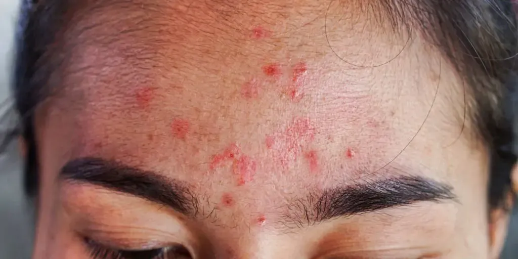 przyczyny pryszczy na czole