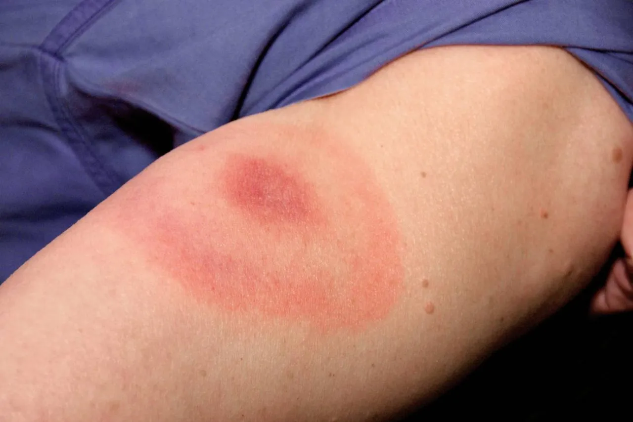 wizyta u lekarza rumień po kleszczu