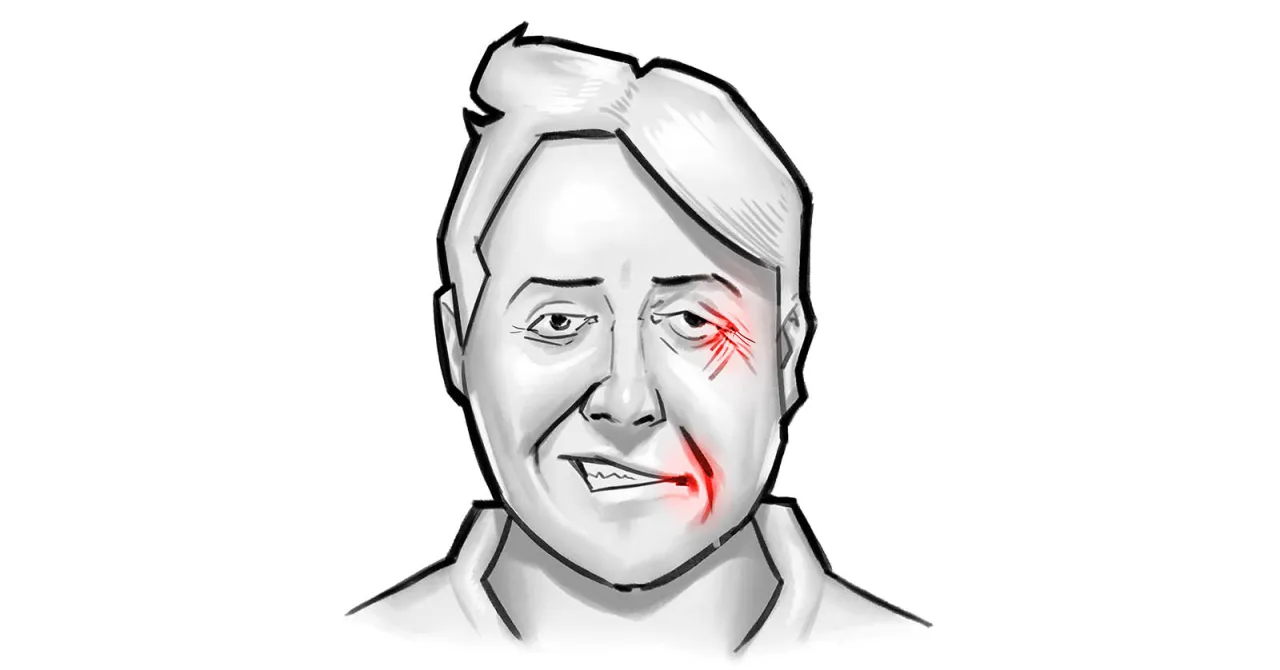 objawy porażenia nerwu twarzowego