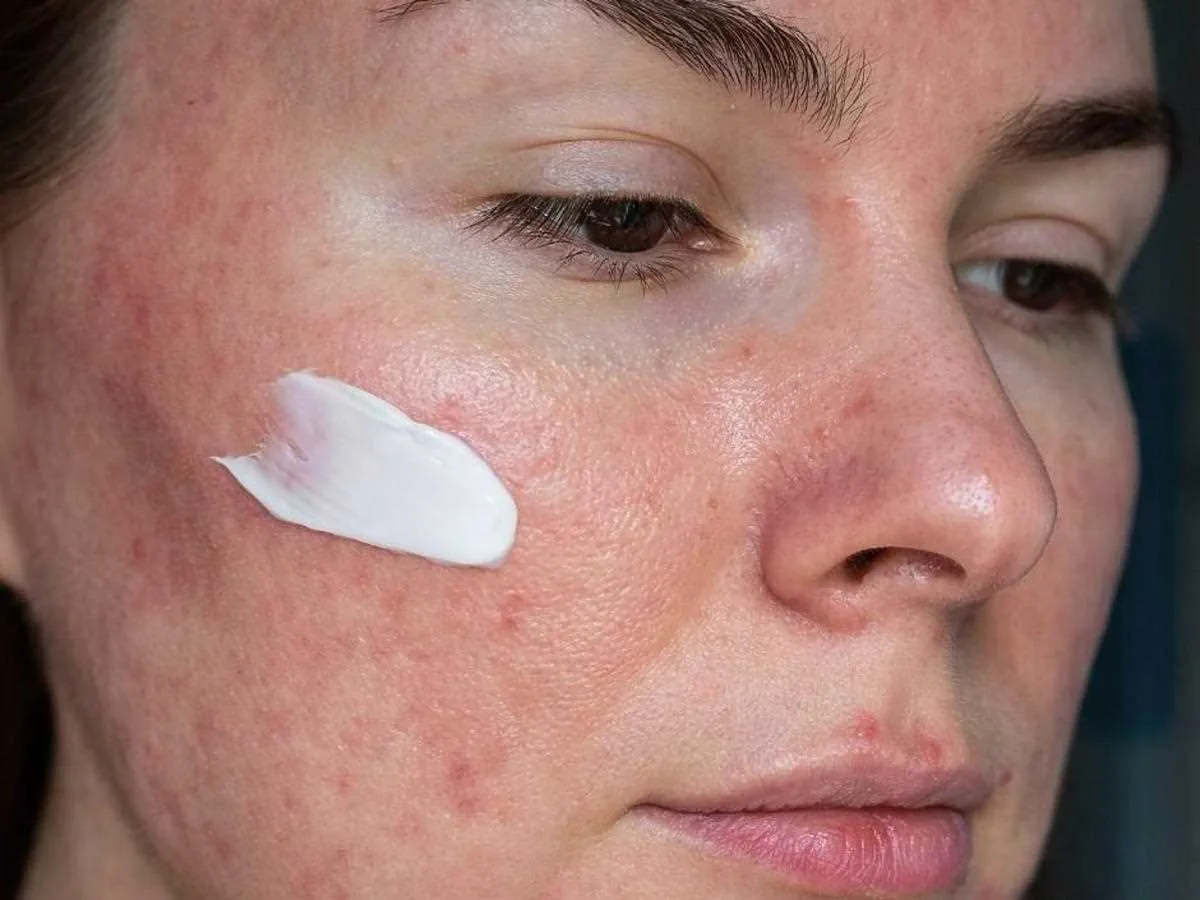 Zdjęcie Skuteczne sposoby na pryszcze podskórne – jak je wyleczyć i uniknąć