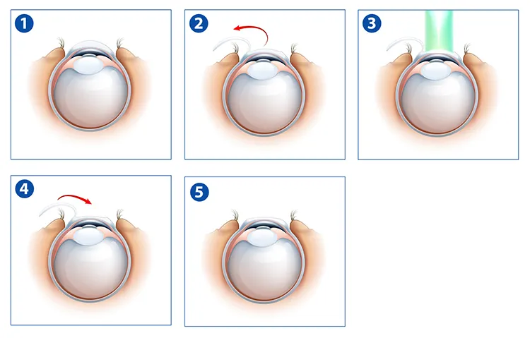 Metody korekcji krótkowzroczności: okulary, soczewki, laser