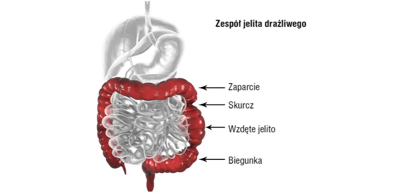 Zdjęcie Gdzie jest jelito drażliwe? Objawy i skuteczne metody leczenia