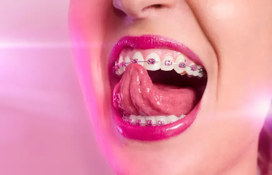Zdjęcie Ile kosztuje aparat na zęby dla 13-latki? Sprawdź ceny i opcje.