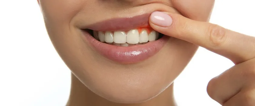 Zdjęcie Czym płukać dziąsła w ciąży, aby uniknąć bólu i problemów?