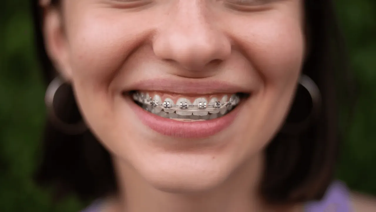 Zdjęcie Nakładki na zęby czy aparat - co wybrać dla idealnego uśmiechu?